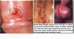 Cara cepat penyembuhan penyakit raja singa Cara cepat penyembuhan penyakit raja singa