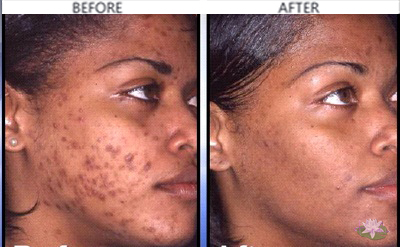 best over the counter acne treatments best over the counter acne treatments