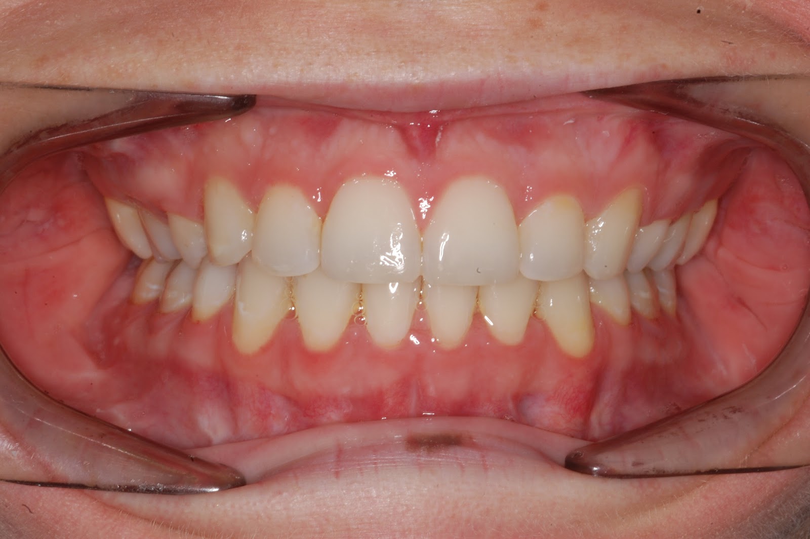 Truman Orthodontics Orthognathic Surgery