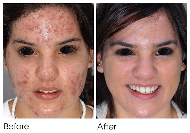 Acne treatment before after Dr. Shazia Ali