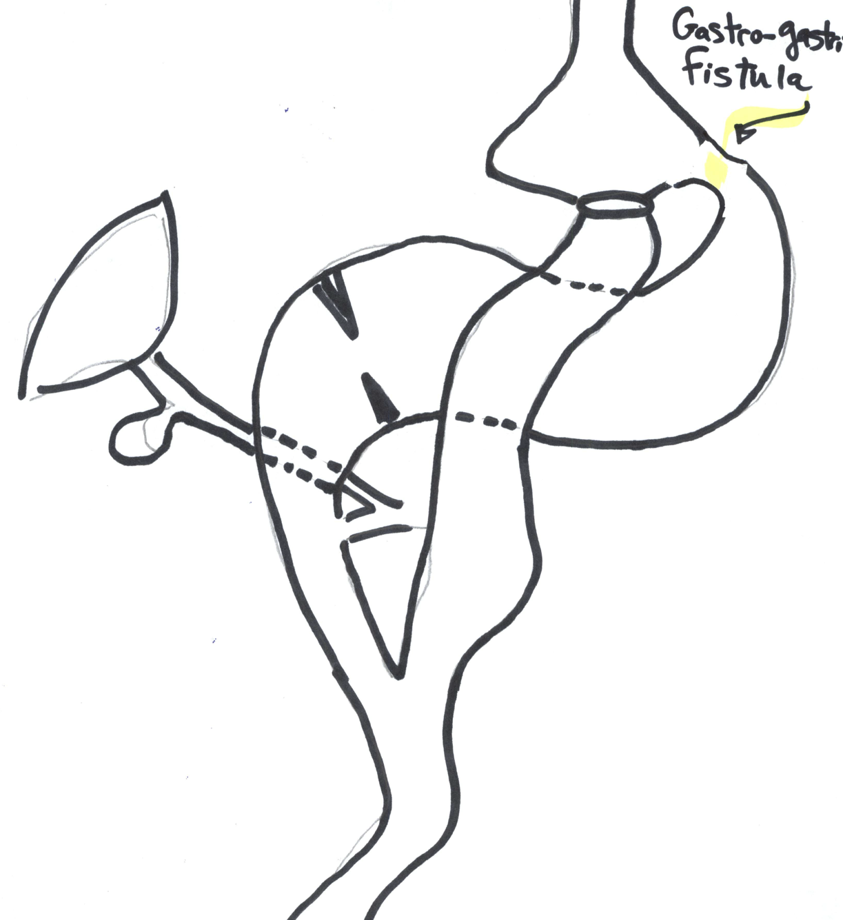 Gastrogastric fistula after gastric bypass operation DSSurgery