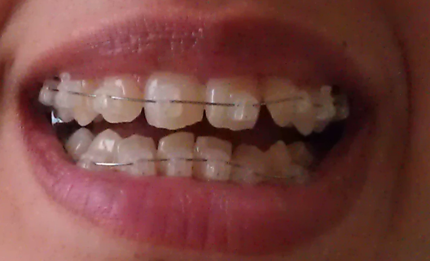 My Damon Clear Braces Day 17 gingivitis scare and loose teeth