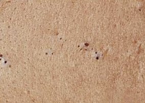 Image of Blackheads