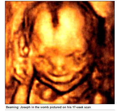 微笑胎兒 - 微笑胎兒出生了