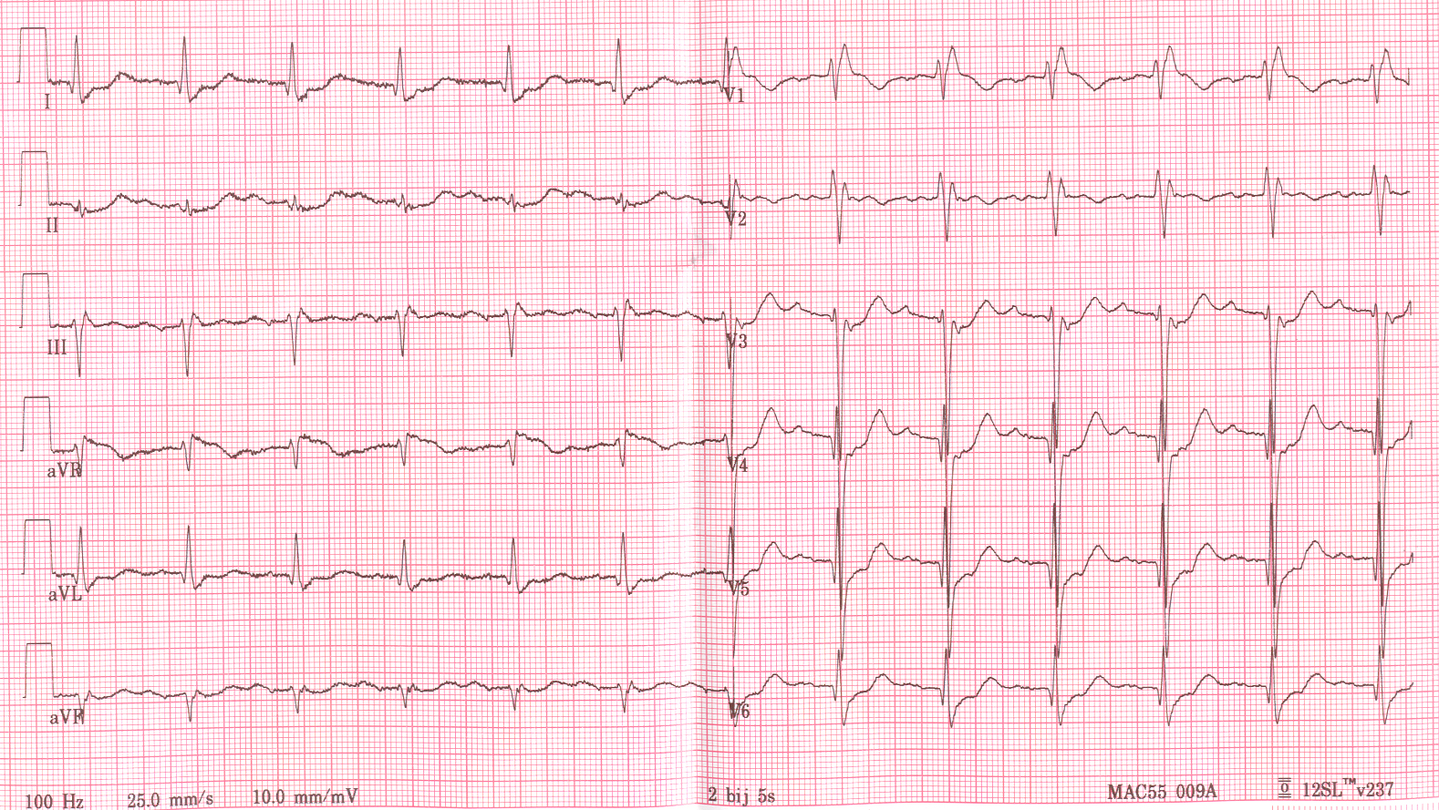 Right Bundle Branch Block V1 Viewing Gallery