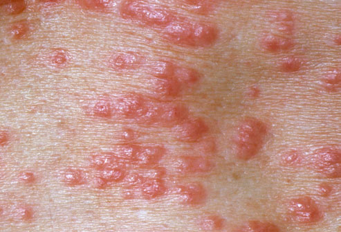 Scabies Contagious Period Cdc