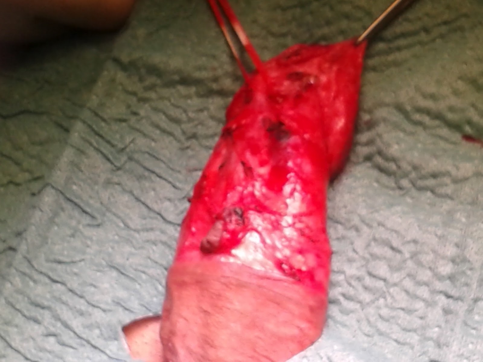 Penile Cancer Photos