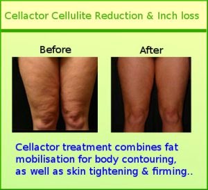 Cellactor Cellulite Reduction & Inch loss Treatment