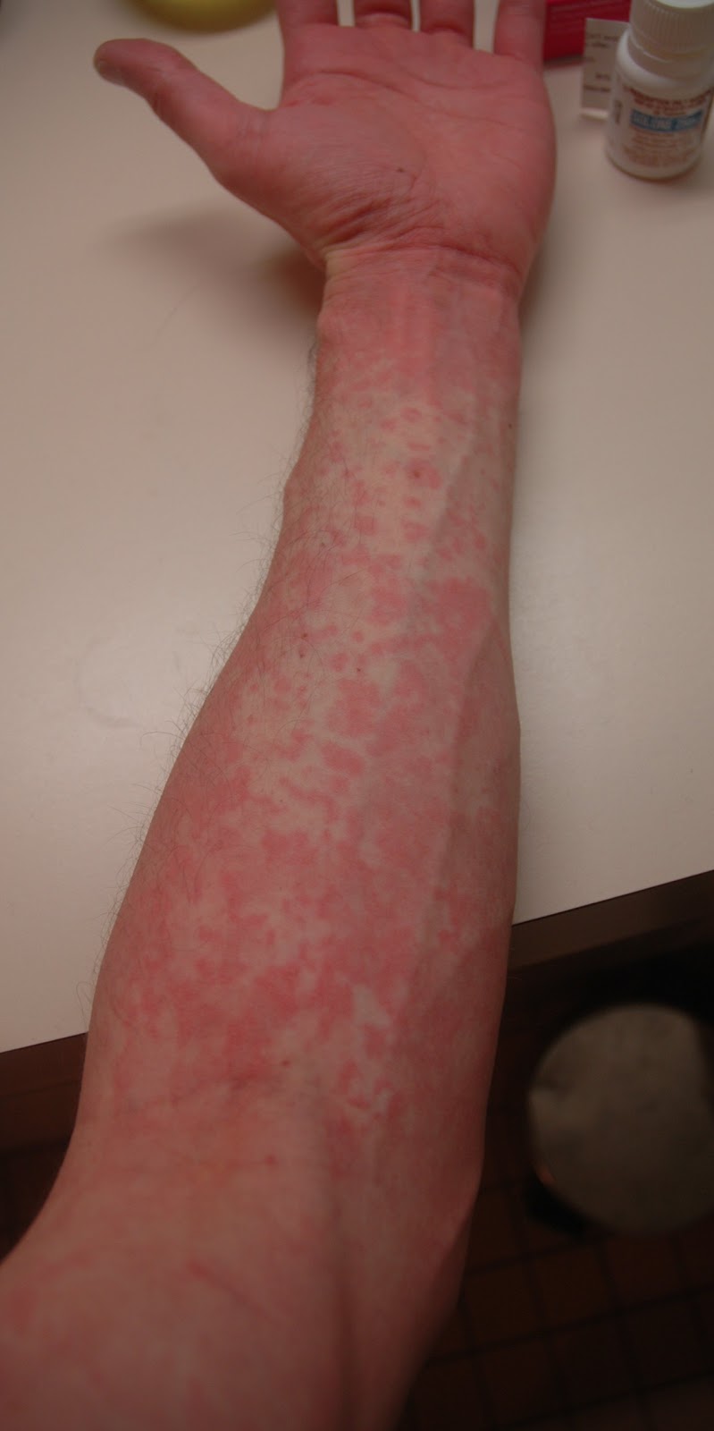 Rashes On Forearms