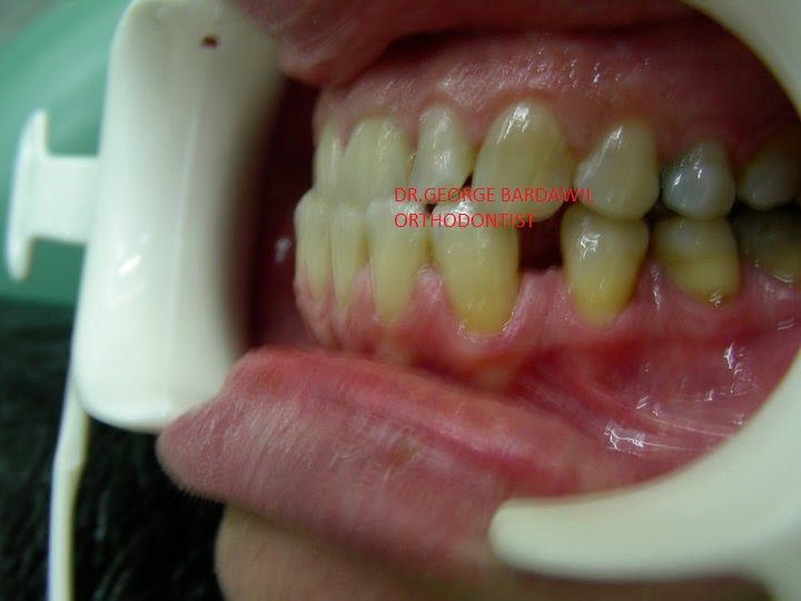 Dr.George E. Bardawil-Orthodontist-Invisalign Diamond level : CLASS 3