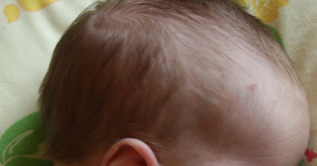 Mellow Mummy Can a newborn baby catch Chicken Pox? YES! Taking life