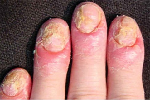 Fungo candidiasis do que tratar