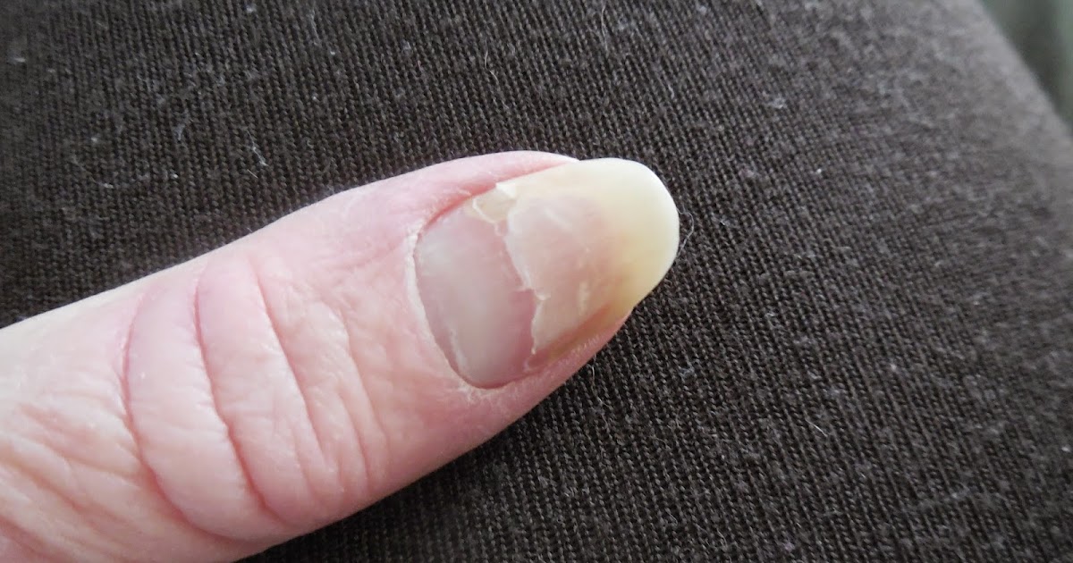 CHOCOLATE, One of My Many Addictions Chemo Side Effect Bad, Ugly