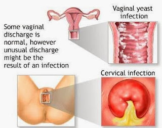 article causes vaginal burning article causes vaginal burning