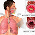 ASTHMA TREATMENT IN HOMEOPATHY