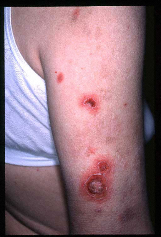 Bronchitis Info Bronchitis Contagious period After Antibiotics