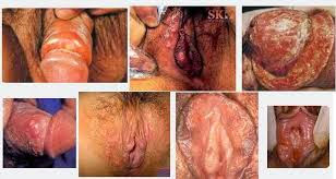 obat luka sifilis obat sifilis laten obat sipilis laten obat sipilis murah obat sipilis malaysia obat sipilis menurut dokter obat sipilis medis obat mujarab sifilis obat sipilis manggis obat mengobati sipilis obat menghilangkan sipilis obat mujarab sipilis obat sipilis paling mujarab obat sipilis yg manjur obat sipilis yang murah obat manjur sipilis obat untuk mengatasi sipilis obat untuk menghilangkan sipilis nama obat sifilis generik nama obat sipilis di apotik anjuran dokter nama obat sipilis di malaysia nama obat sipilis paling ampuh nama obat sipilis nama obat sipilis resep dokter nama obat sipilis raja singa nama obat sipilis apotik obat sipilis online obat oral sifilis obat luka sifilis obat sifilis laten obat sipilis laten obat sipilis murah obat sipilis malaysia obat sipilis menurut dokter obat sipilis medis obat mujarab sifilis obat sipilis manggis obat mengobati sipilis obat menghilangkan sipilis obat mujarab sipilis obat sipilis paling mujarab obat sipilis yg manjur obat sipilis yang murah obat manjur sipilis obat untuk mengatasi sipilis obat untuk menghilangkan sipilis nama obat sifilis generik nama obat sipilis di apotik anjuran dokter nama obat sipilis di malaysia nama obat sipilis paling ampuh nama obat sipilis nama obat sipilis resep dokter nama obat sipilis raja singa nama obat sipilis apotik obat sipilis online obat oral sifilis
