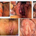 Obat Sipilis Aman Paling Manjur thumbnail