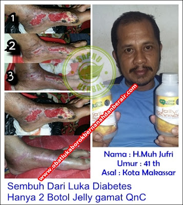 Obat Luka Gangren Tradisional Terampuh , Terbukti Manjur !! Obat Luka Gangren Tradisional Terampuh , Terbukti Manjur !!