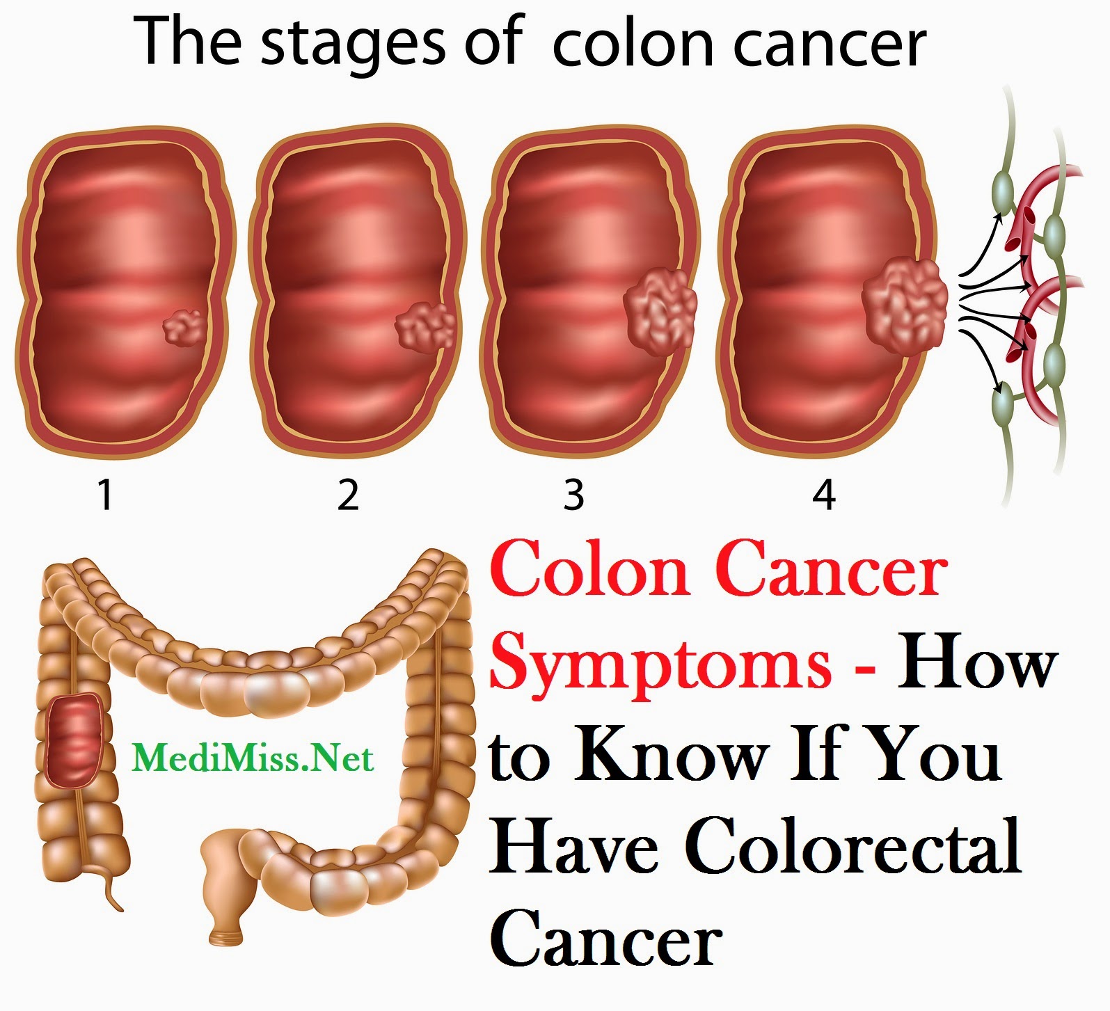 Image Result For Colon Cancer Treatment Pdq Health Professional Version Image Result For Colon Cancer Treatment Pdq Health Professional Version