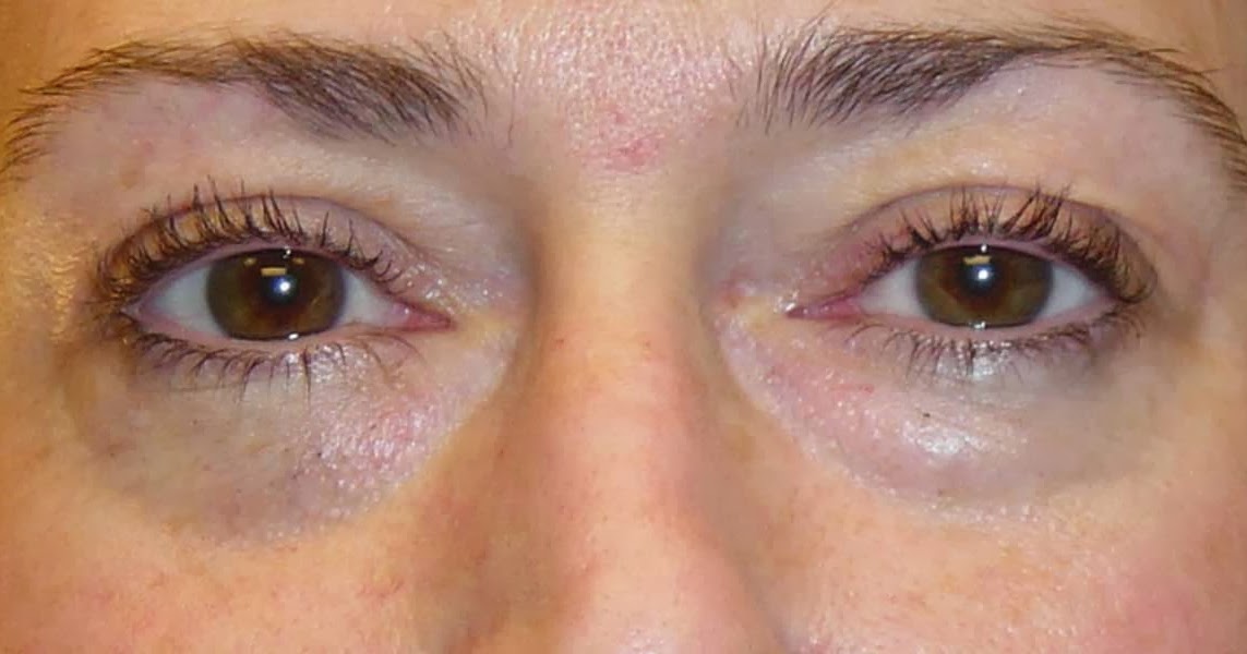 Perfect Body Laser and Aesthetics Nonsurgical Upper/Lower Eye Lid Lift