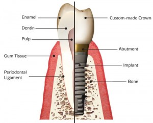 Tooth implant Tooth implant