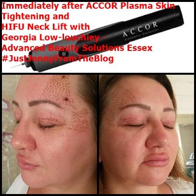 Non Surgical Brow Lift by Georgia Low Louchiey