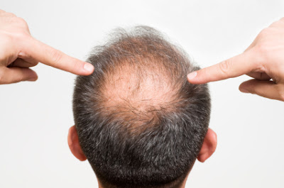 natural solutions for hair loss