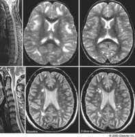 Ms Brain Lesions