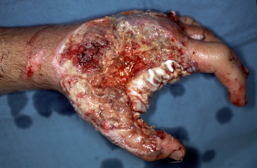 flesh-eating-bacteria-pictures-symptoms5.jpg