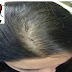علاج الحالات المستعصية من تساقط الشعر