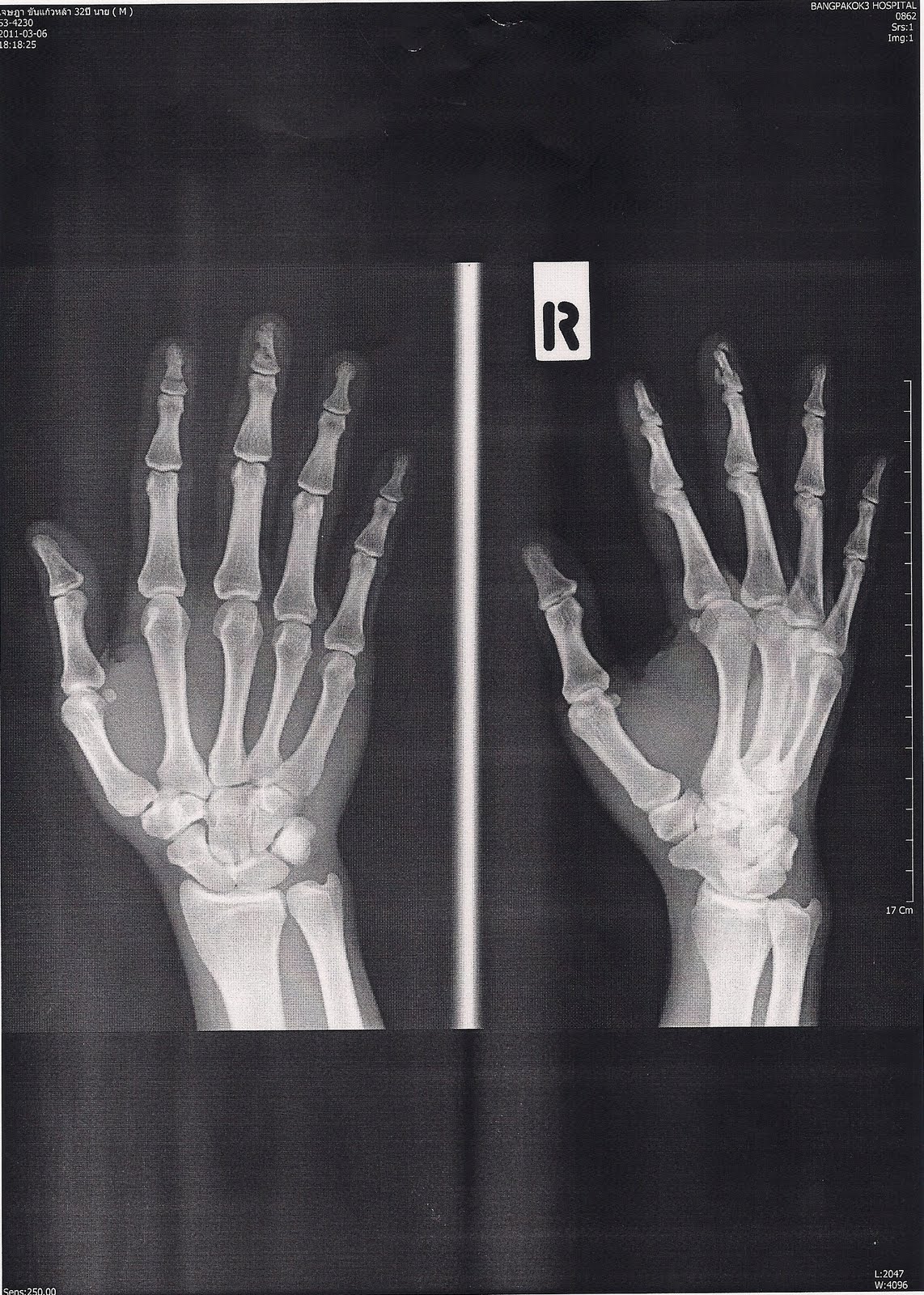 RC Airplane Safety Awareness Hit by rc airplane propeller Part2