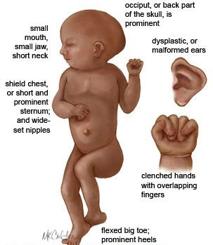 Edwards Syndrome Trisomy Trisomy PubMed Health National Center for Biotechnology