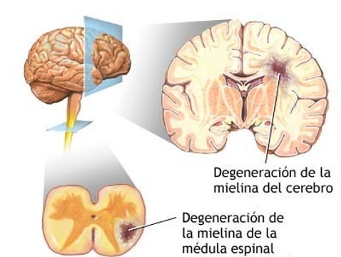 enfermedades del sistema nervioso central pdf