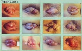 obat alami wasir atau ambeien obat alami wasir atau ambeien