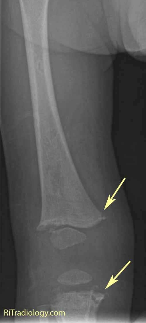 Distal Femur Fracture-4.bp.blogspot.com the femur demonstrates classic metaphyseal lesions of the distal femur