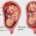 MASALAH URI DI BAWAH / PLACENTA PREVIA : ADAKAH BAHAYA?