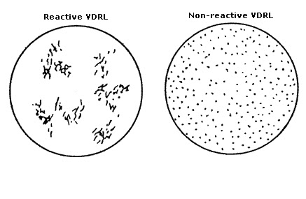 Vdrl exame