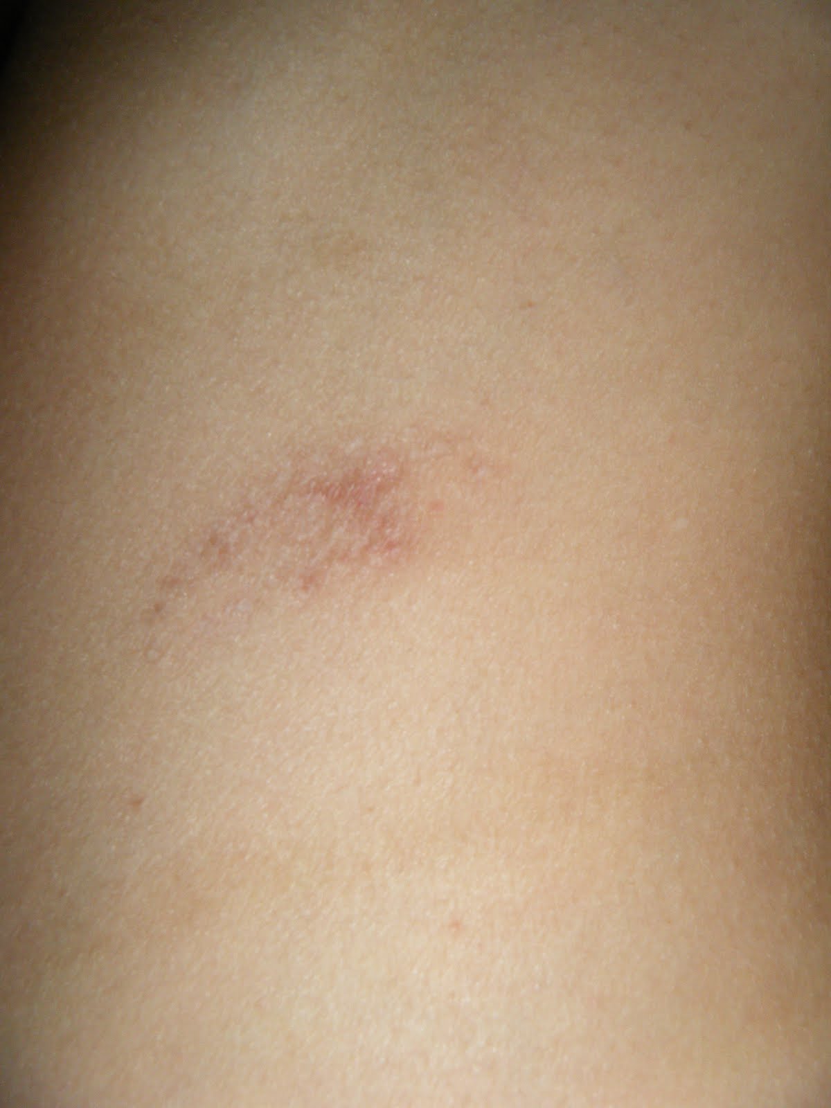 21 and Shingles Shingles scars