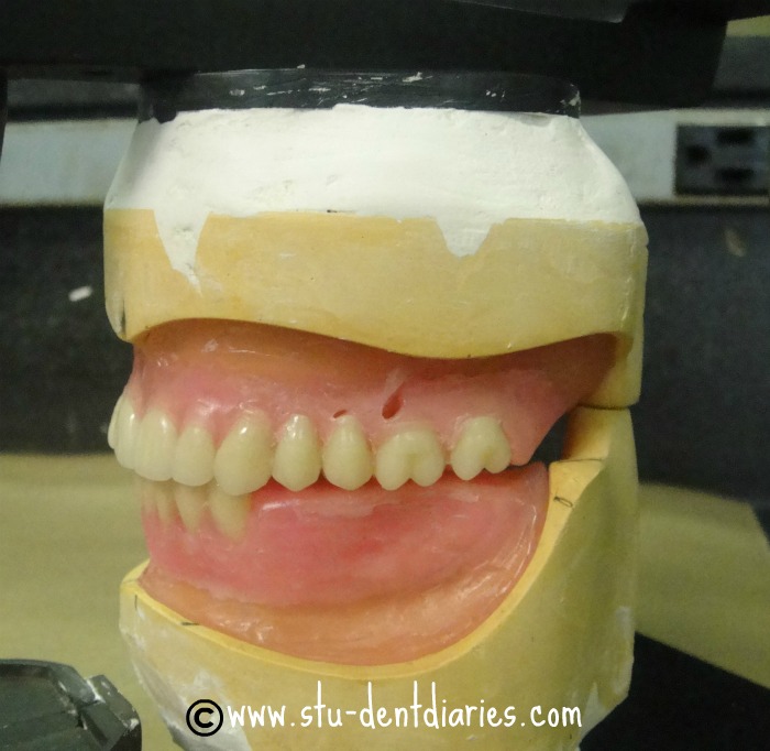 teeth setting