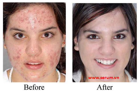 Serum trị mụn, serum trị nám cho làn da đẹp không tì vết Serum trị mụn, serum trị nám cho làn da đẹp không tì vết