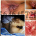 Cara Mengobati Wasir (Hemoroid) yang Sudah Menahun Kronis thumbnail