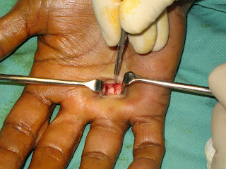 Consider, that Trigger thumb release surg Trigger thumb release surg