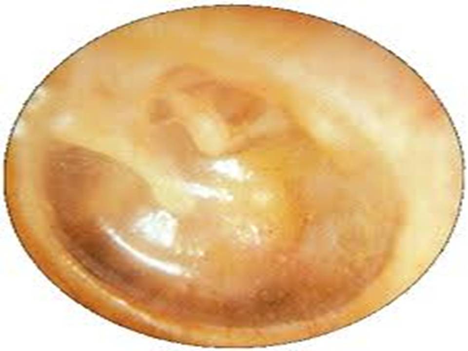 المدونة الطبية د.فهيد سالم السبيعي ADHESIVE OTITIS M