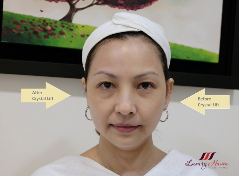 EHA Clinic Take Years Off With Crystal Lift Therapy!