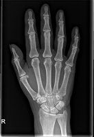 x-ray of hand x-rays