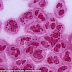 Sex superbug, Drug-Resistant Gonorrhea could rival AIDS thumbnail