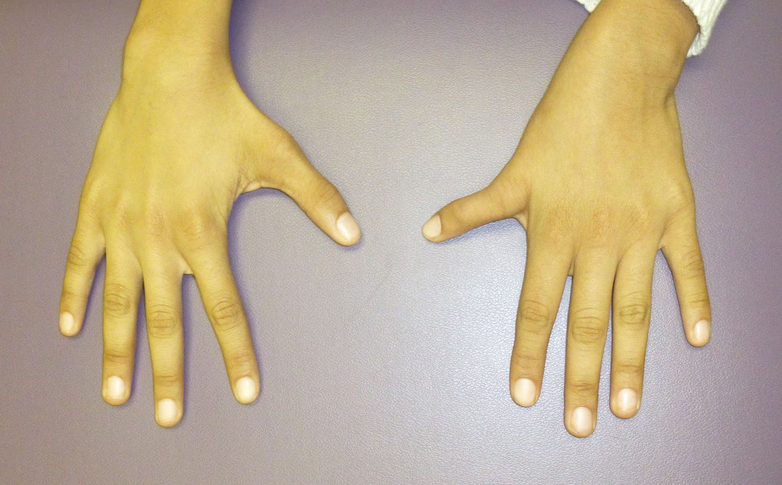 Small thumbs Congenital Hand and Arm Differences