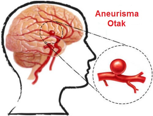 Aneurisma cerebral viagra Aneurisma cerebral viagra