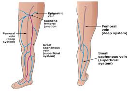 Donna: Endovenous Laser Treatment of the Small Saphenous Vein